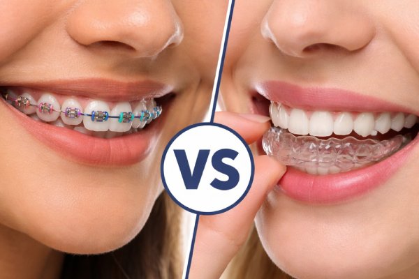 Invisalign Vs Dental Braces Which Is Right For You? | Stuart, FL