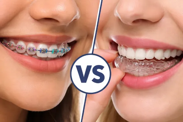 Invisalign Vs Dental Braces Which Is Right For You? | Stuart, FL