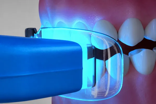 Teeth Whitening Compatible With Dental Implants | Stuart