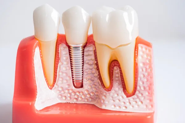 Top 7 Myths About Dental Implants in Stuart Debunked