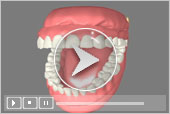3D Dental Patient Education Immediate Dentures