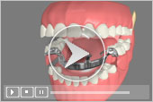 3D Dental Patient Education Partial Dentures