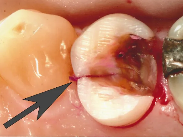 Cracked Tooth