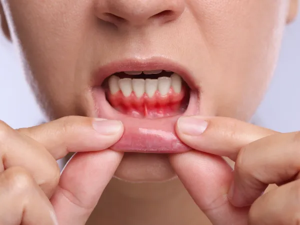 Periodontal Care